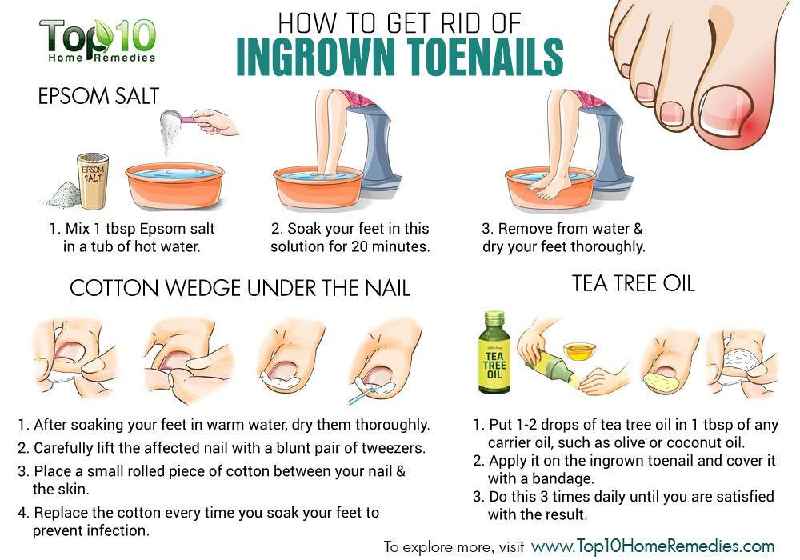 how-to-take-care-of-a-toe-after-nail-removal