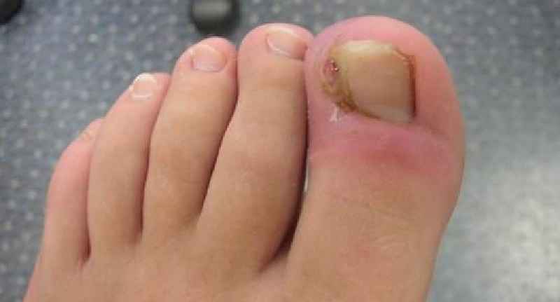 How do you treat toe after toenail removal