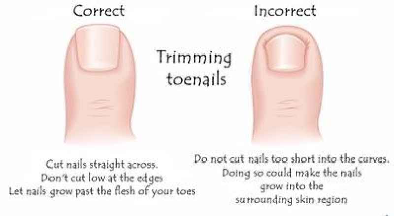 How do you trim thick diabetic toenails