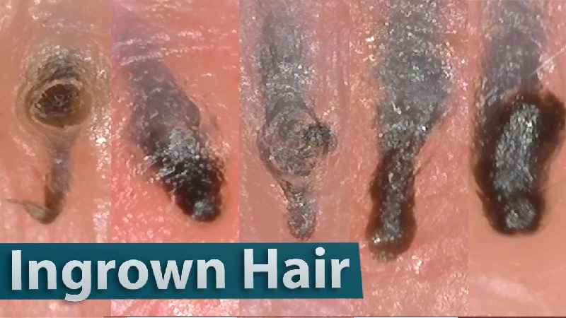 How does a dermatologist remove ingrown hair