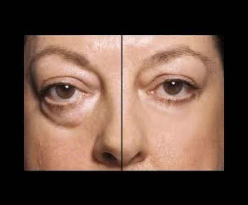 How does a dermatologist remove under-eye bags