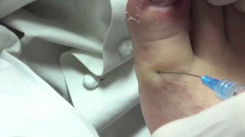 How does a podiatrist treat thick toenails