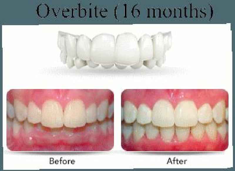 How does Invisalign correct overbite