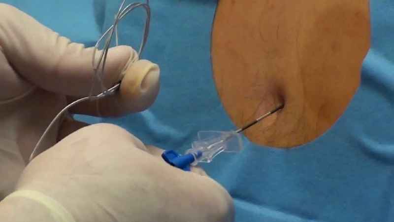 How does local anesthesia work