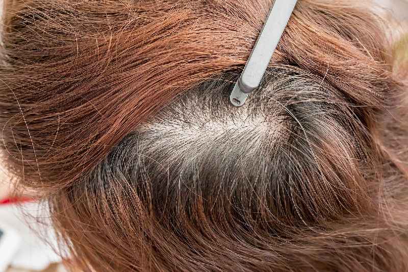 How does Wellbutrin stop hair loss
