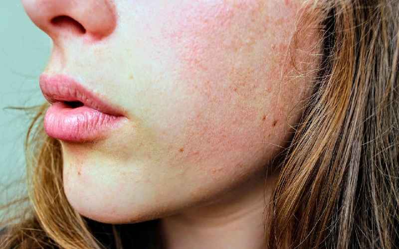 How fast can acne clear up