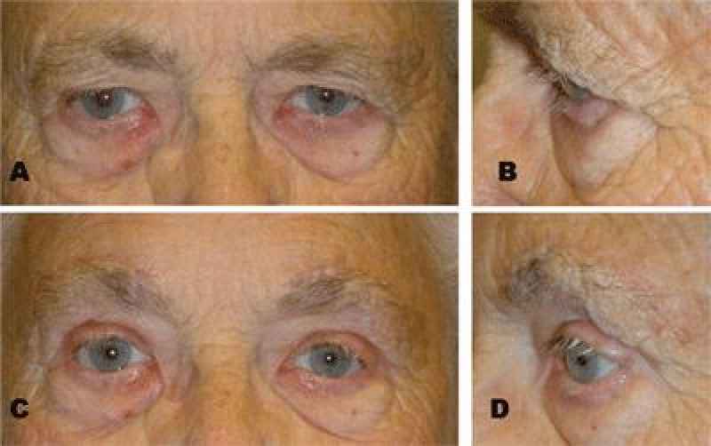 How invasive is an eyebrow lift