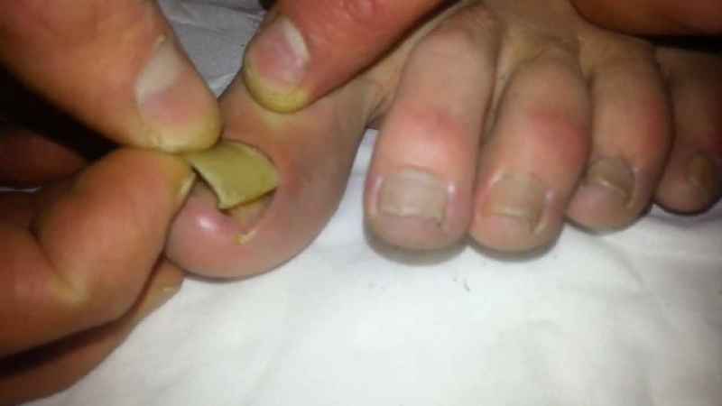 How is a toenail permanently removed