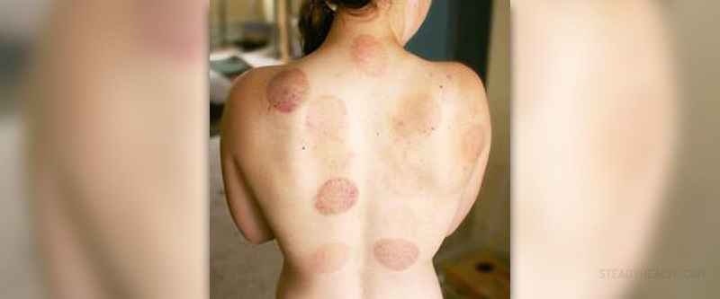 How is cupping different from massage
