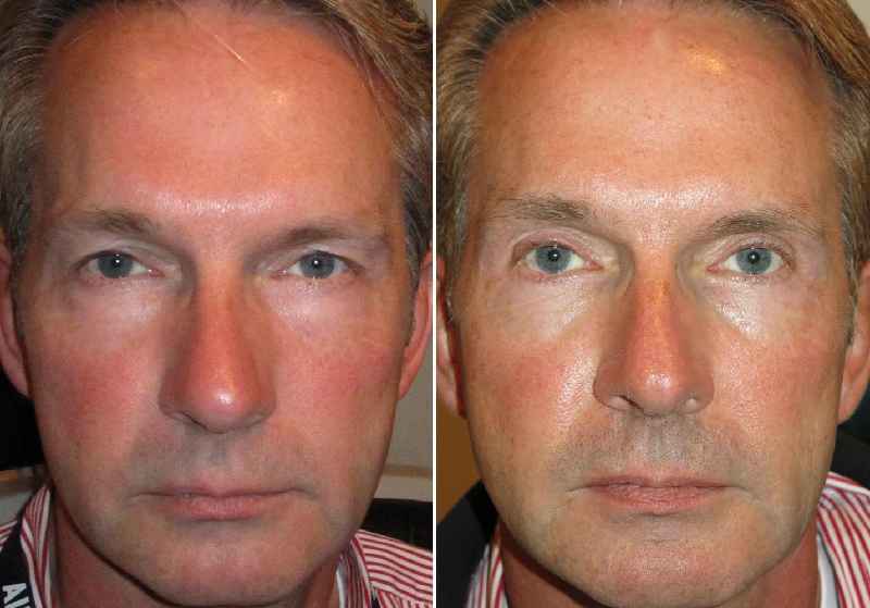 How is lower lid blepharoplasty done