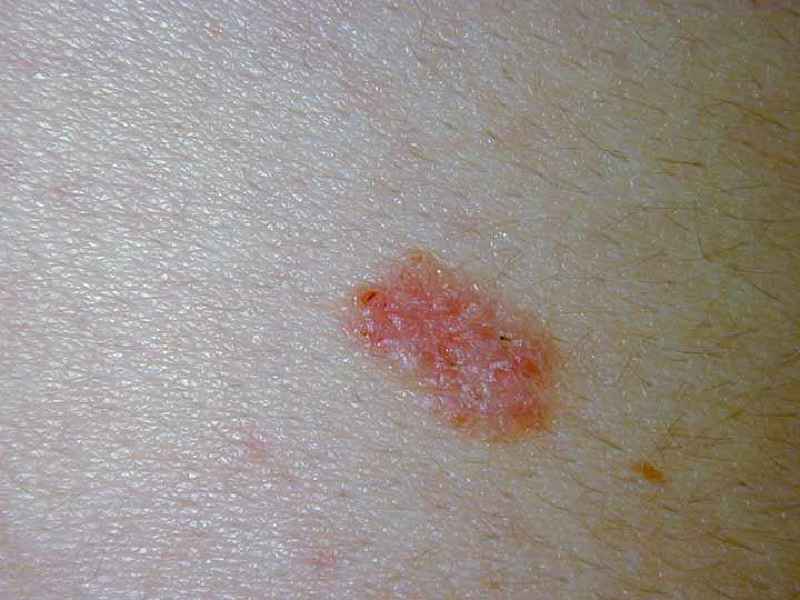 How is skin cancer detected