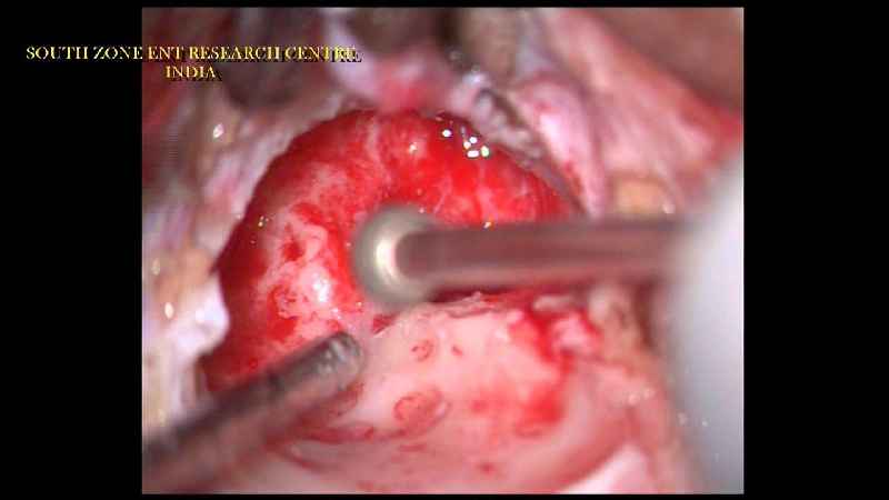 How is tympanoplasty done