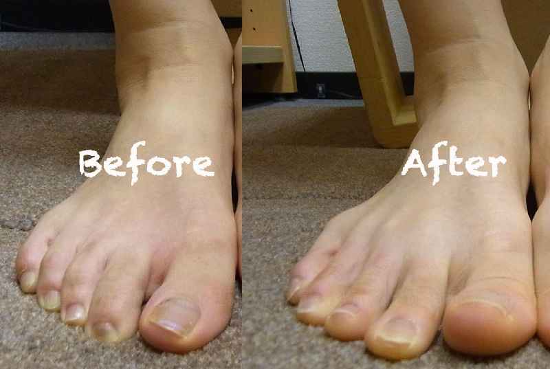 How long after toenail surgery can I walk