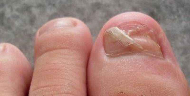 How long do nail beds take to heal