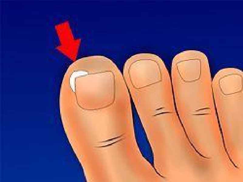 How long do you leave dental floss under ingrown toenail