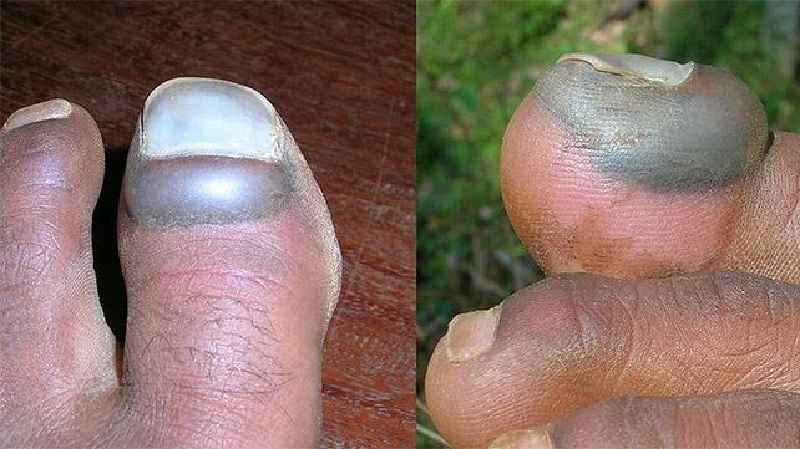 How long does a nail bed laceration take to heal