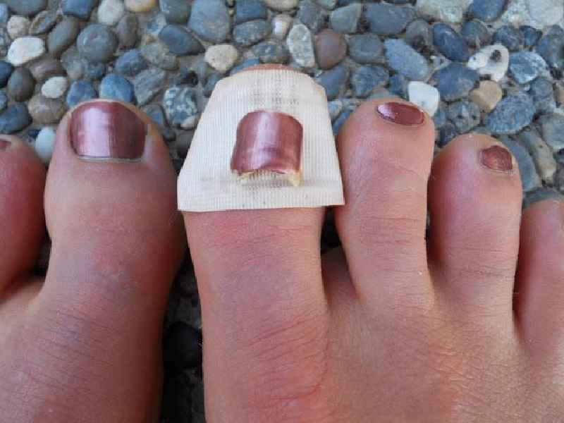 How long does a ripped off toenail hurt