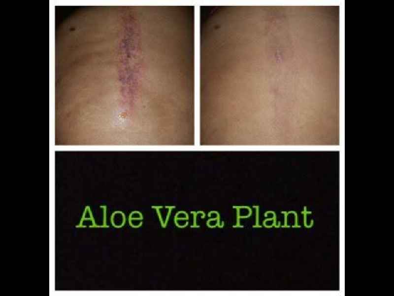 How long does aloe vera take to fade scars