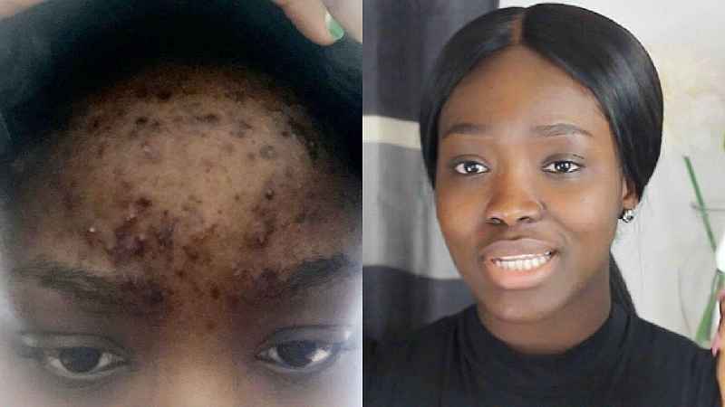 How long does BHA take to clear acne