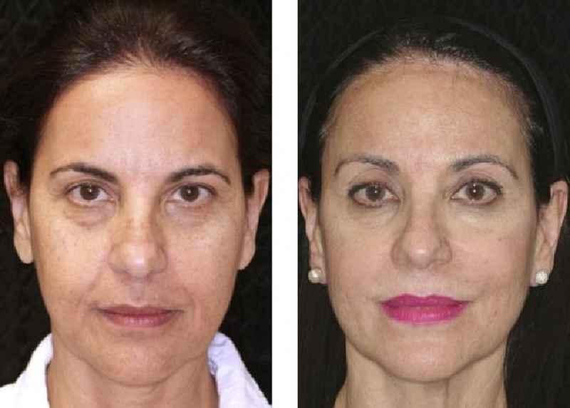 How long does chin laser last