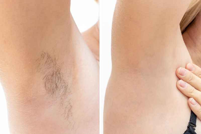 How long does flawless hair removal last