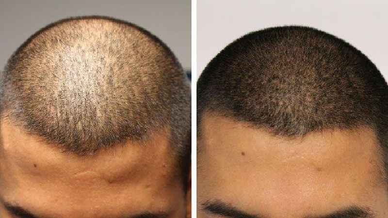 How long does hair loss from medication last