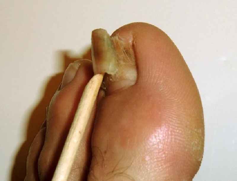 How long does it take a toenail to grow back after fungus