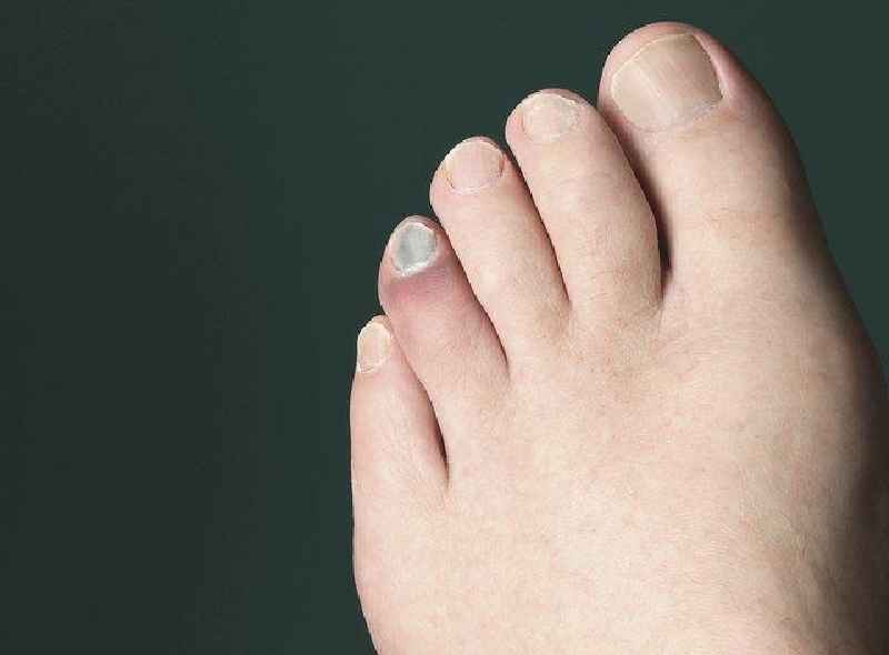How long does it take for a big toe nail to heal