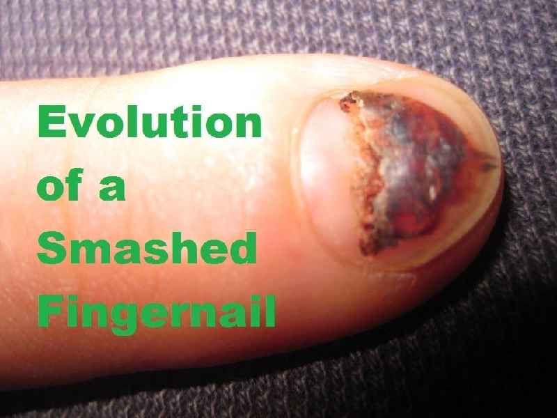 How long does it take for a damaged nail to fall off