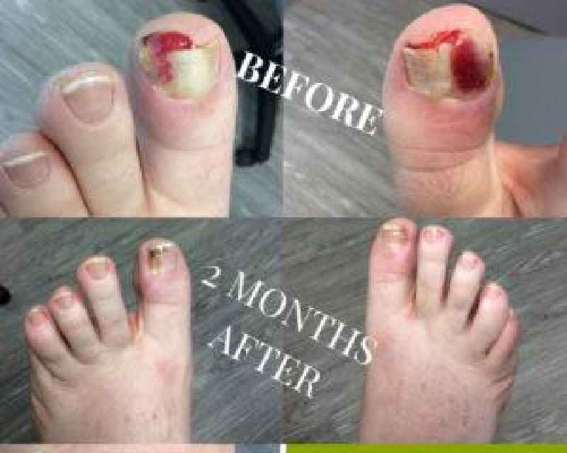 How long does it take for a permanent toenail removal to heal