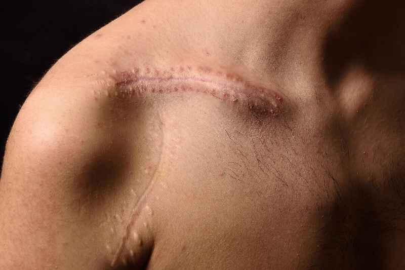 How long does it take for a scar to heal after stitches