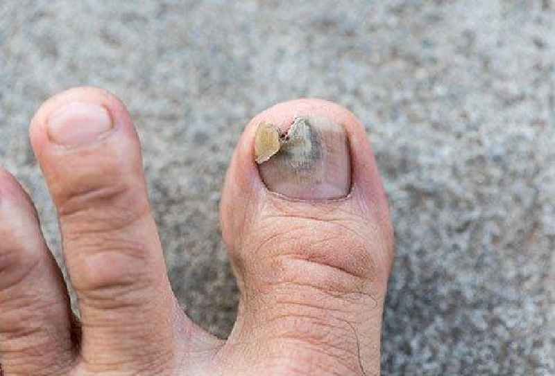How long does it take for a wound under the nail to heal