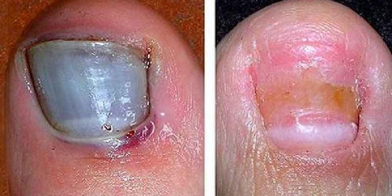 How long does it take for an exposed nail bed to heal