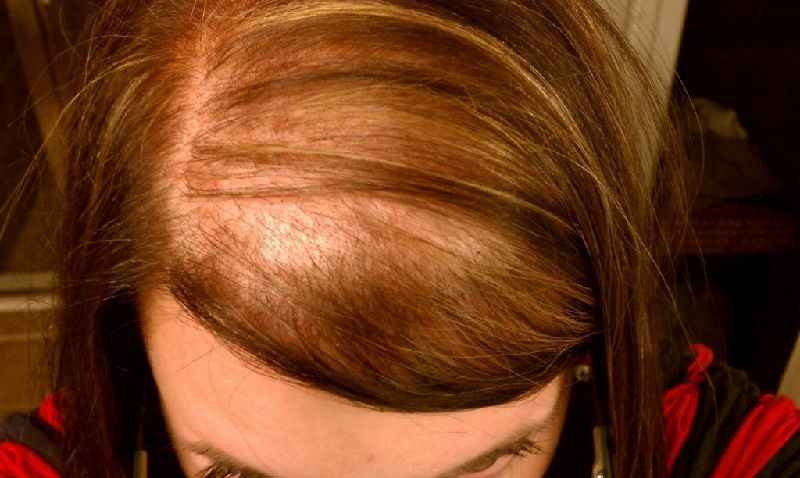How long does it take for hair to grow back after hormonal hair loss