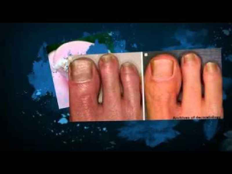 How long does it take for Vicks to work on nail fungus