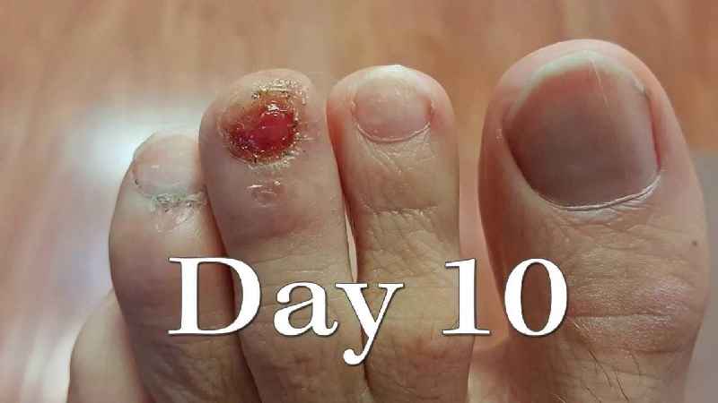 How long does it take for your toe to heal after nail removal