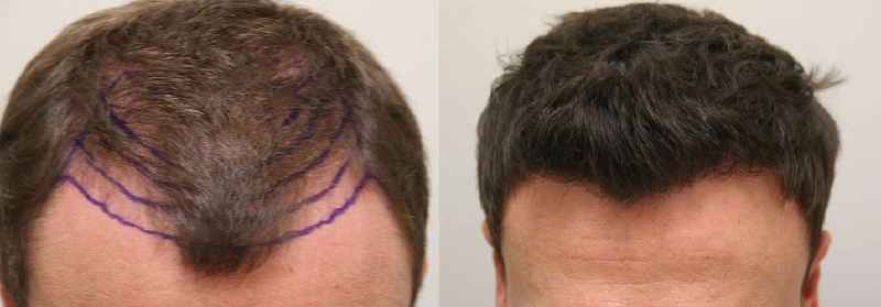 How long does it take to regrow hair after hair loss