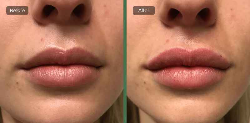 How long does Juvederm last in cheeks