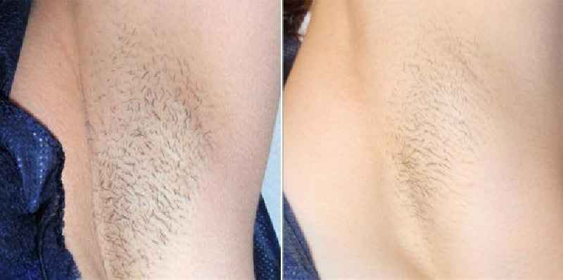 How long does laser hair removal take underarms