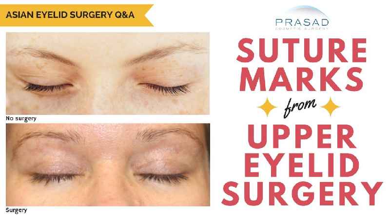 How long does lower blepharoplasty surgery take