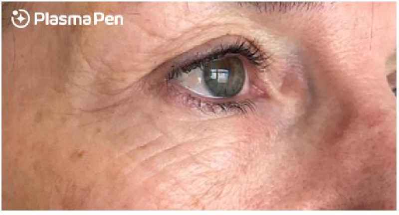 How long does non surgical blepharoplasty last