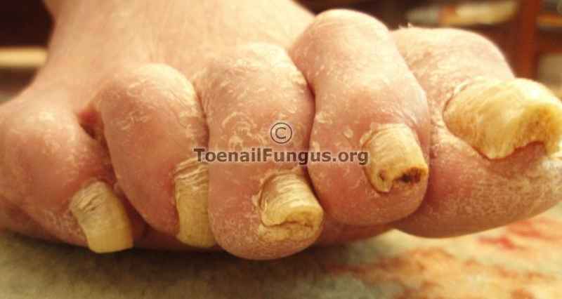 How long does toenail fungus last
