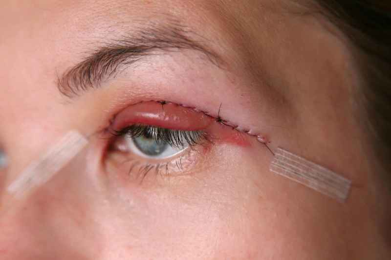How long does upper and lower blepharoplasty last