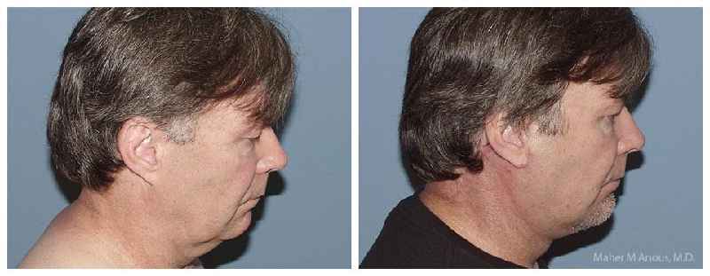 How long is recovery after neck lift
