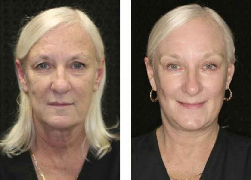 How long is recovery for a neck lift