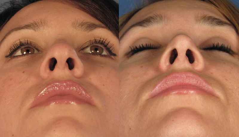 How long is recovery from a nose job