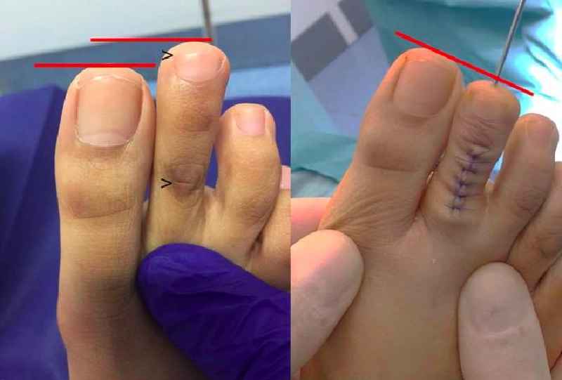 How long is toe sore after toenail removal