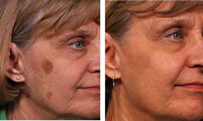 How long should I avoid the sun after microneedling