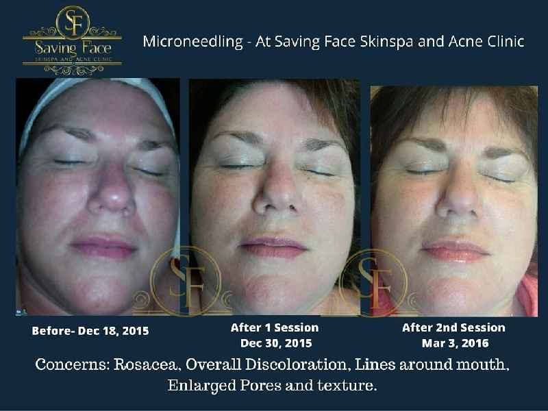 How long should I avoid the sun after Microneedling