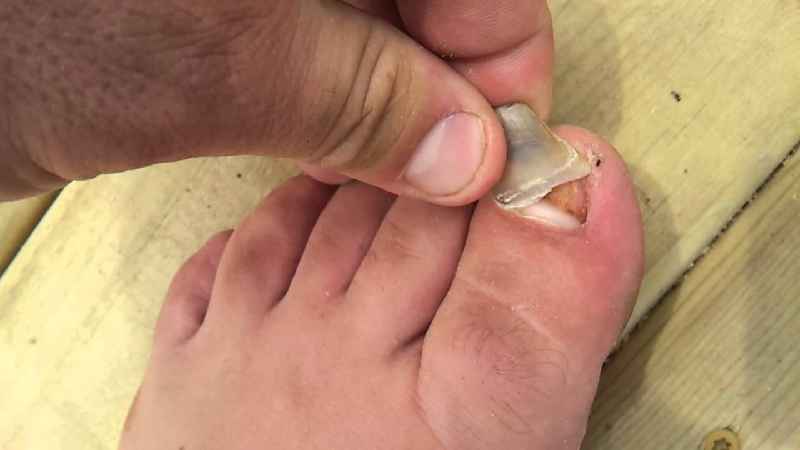 How long will bruised toenail hurt